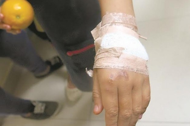 Madre le quema las manos a su hijo de 11 años porque tomó 1,200 pesos