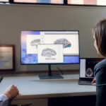epilepsia farmacorresistente